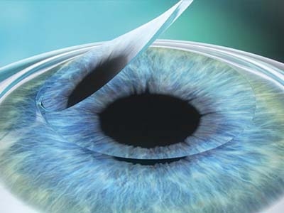 Operacija femto LASIK