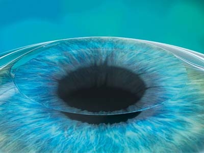 Operacija femto LASIK