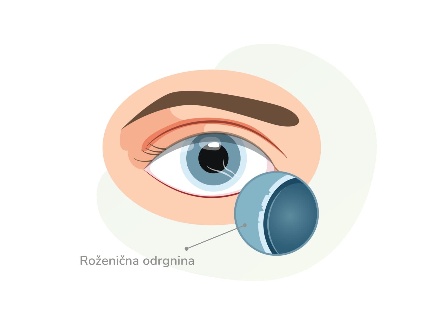 Roženična odrgnina