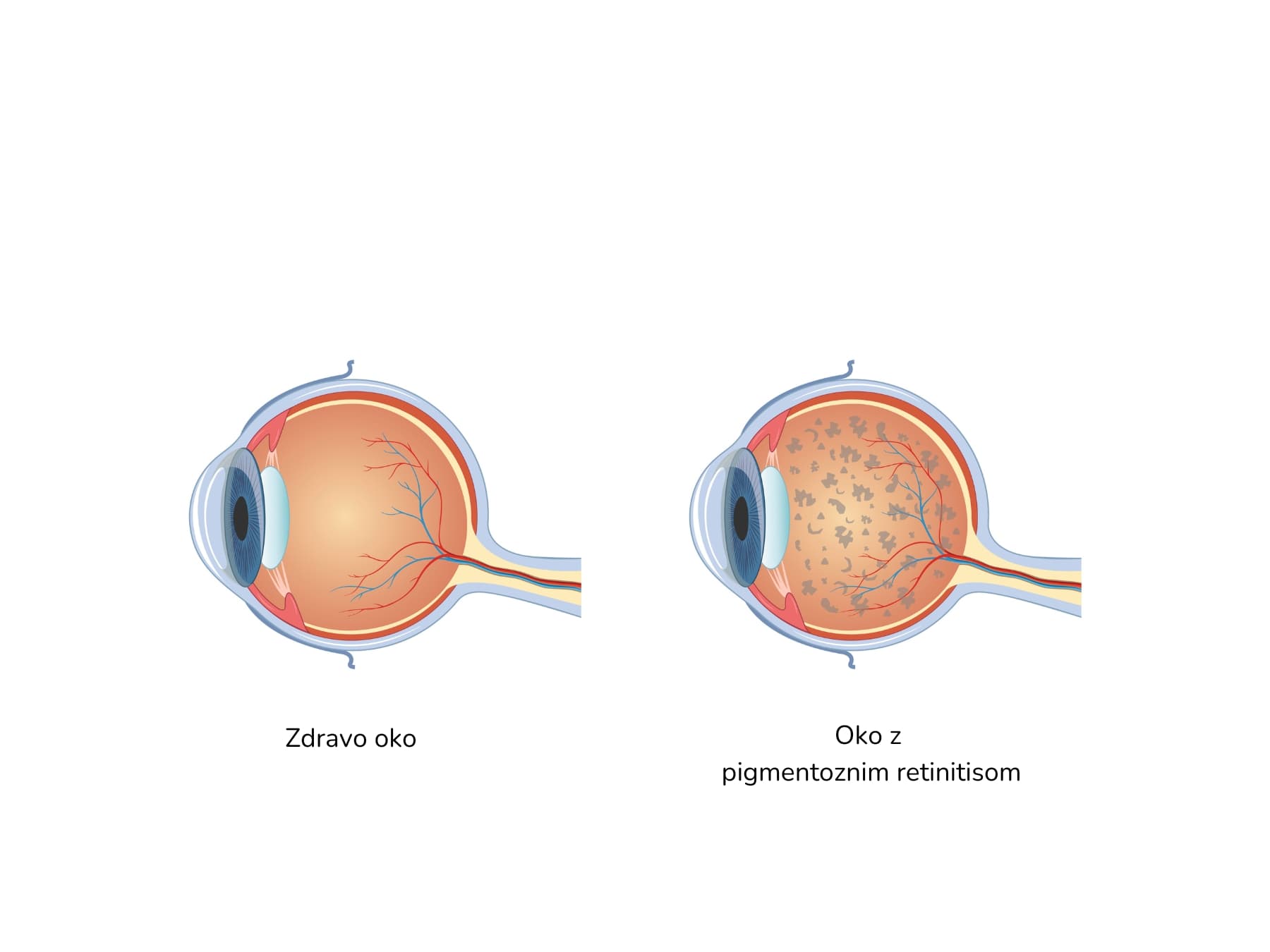Pigmentozni retinitis