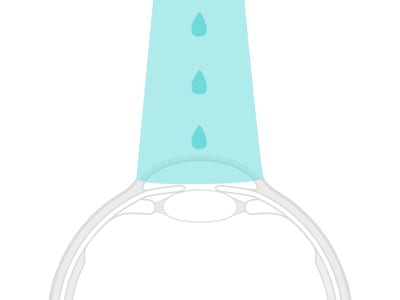 Zdravljenje keratokonusa z metodo Crosslinking