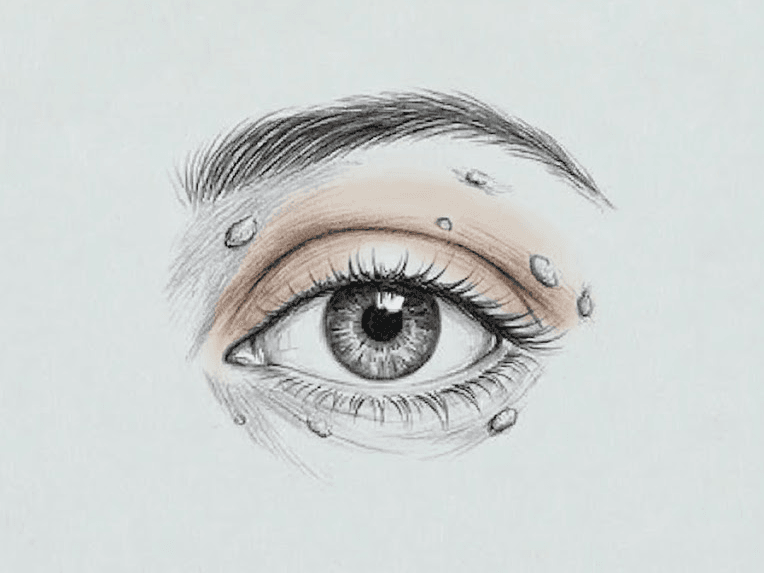 Mali očesni posegi - Ciste