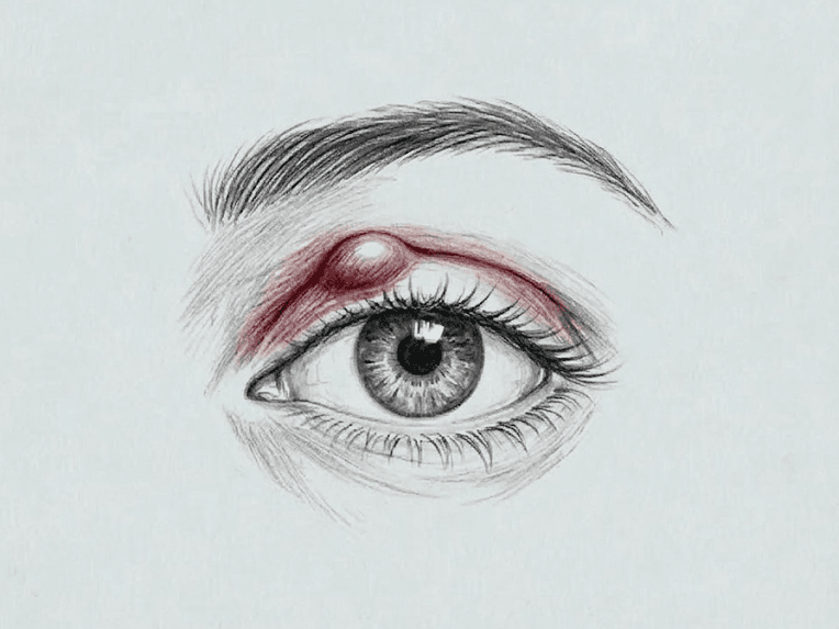 Mali očesni posegi - halacij