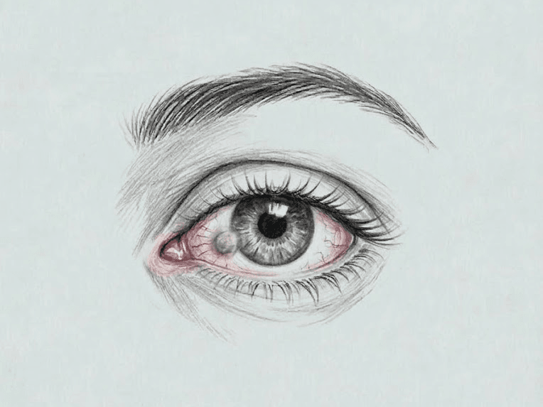 Mali očesni posegi - Pingvekula