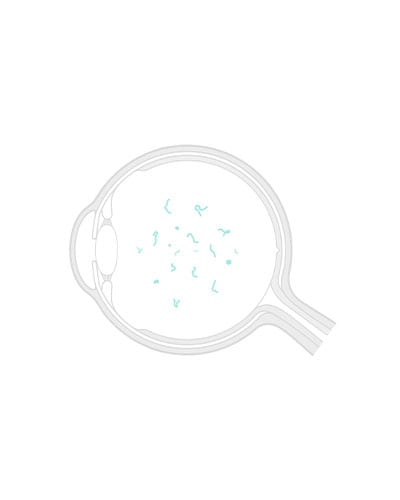 Shematski prikaz očesa z motnjavami