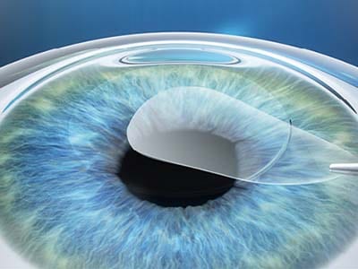 Kirurg skozi površinski rez na robu roženice odstrani tkivno lečko.