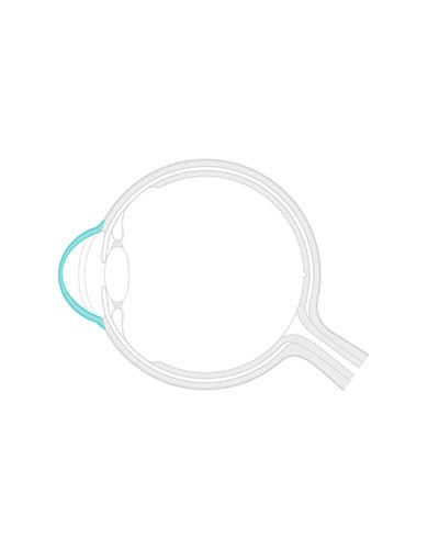 Shematski prikaz očesa s keratokonusom