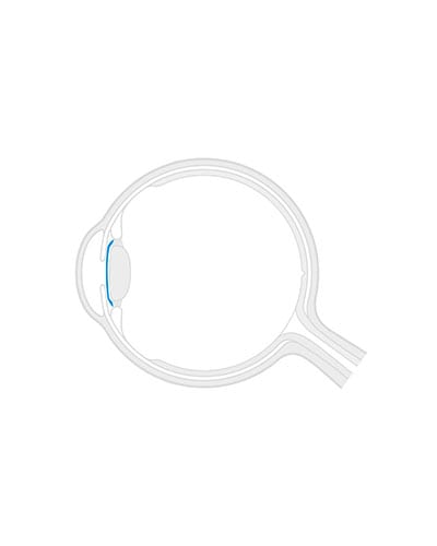 Shematski prikaz očesa z ICL lečo