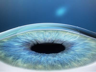 Preoblikovanje roženice popravi optiko in odpravi dioptrijo ter astigmatizem.