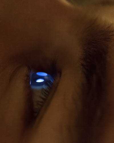 Fotografija očesa s keratokonusom
